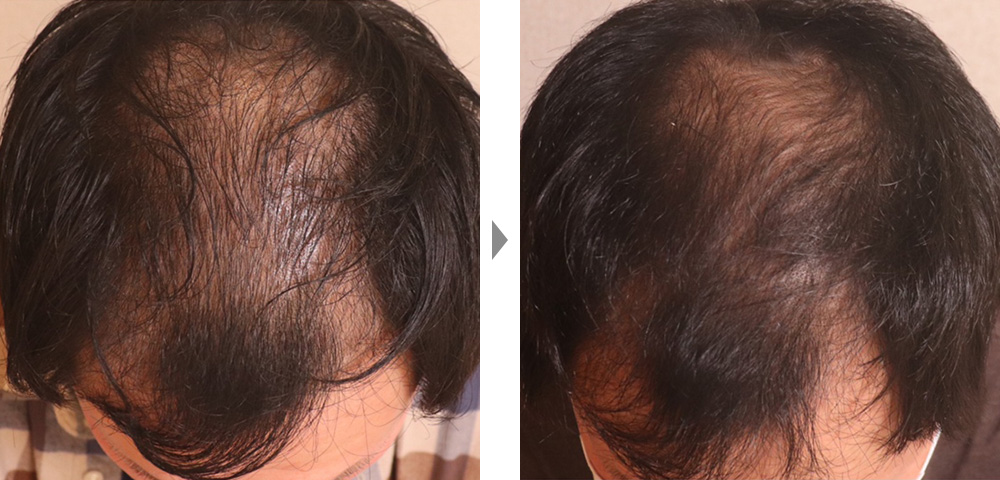 【薄毛・AGA治療（エクソソーム注射）】注目の再生医療による男性のAGA治療の症例写真ビフォーアフター