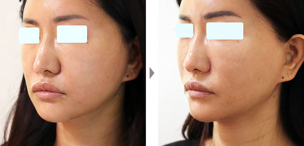 【脂肪溶解注射】VライナーNEOによる小顔治療（1度の施術でシャープなVラインに）の症例写真ビフォーアフター