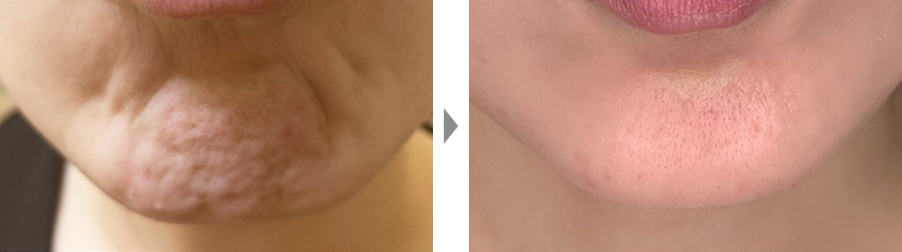 【ボトックス注射】あごの梅干しじわを改善の症例写真ビフォーアフター