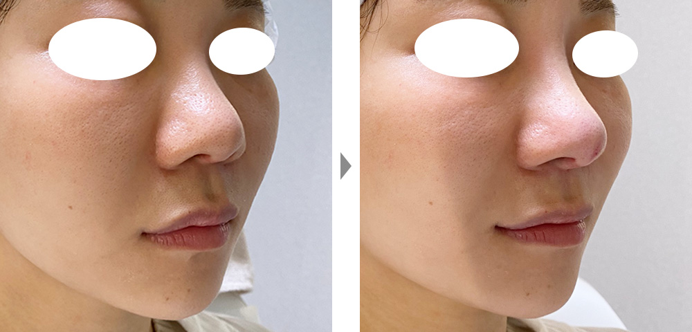 【オリジナル鼻スレッド】上向きの鼻先と鼻筋に高さを出て、短い鼻を改善するの症例写真ビフォーアフター