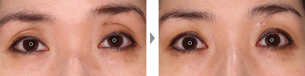【大人黒目法】眼瞼下垂術＋二重整形で上まぶたのたるみとくぼみを改善した症例の症例写真ビフォーアフター