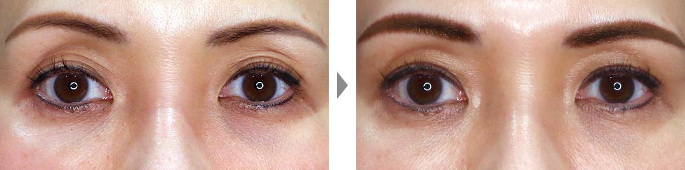 【大人黒目法】眼瞼下垂術＋二重整形による、注入術よりも自然な上まぶたのくぼみ改善術の症例写真ビフォーアフター