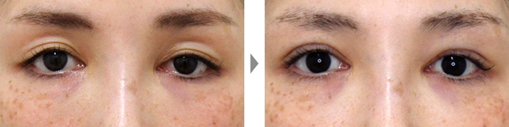 【大人黒目法】加齢による眼瞼下垂を改善し、二重整形で目ヂカラをさらにアップの症例写真ビフォーアフター
