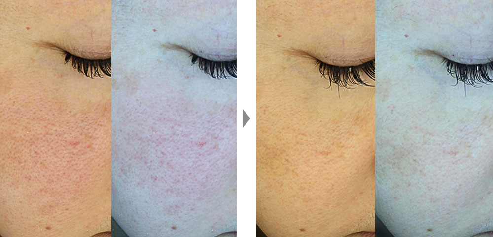 【スネコス注射】肌再生療法による毛穴の開き・黒ずみ、赤ら顔改善の症例写真ビフォーアフター
