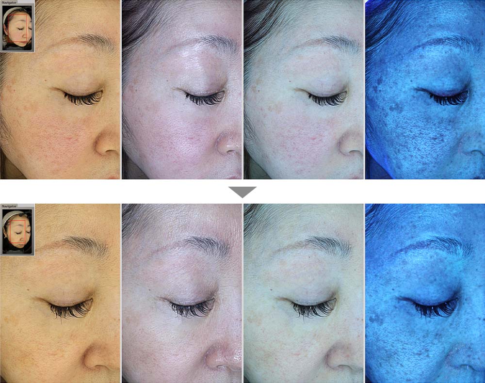【スネコス注射】肌再生療法によるしみ・くすみ・赤ら顔の改善の症例写真ビフォーアフター
