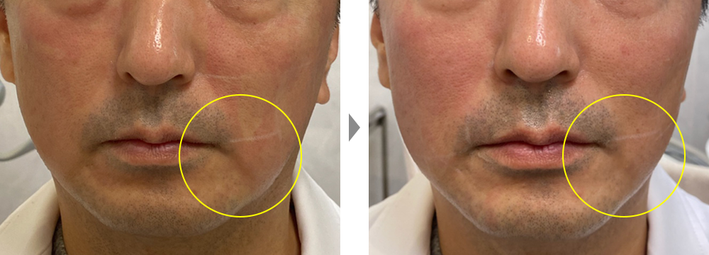 【ウルトラフォーマー3（シュリンク）】口横のポニョ（口角のたるみ）改善治療の症例写真ビフォーアフター