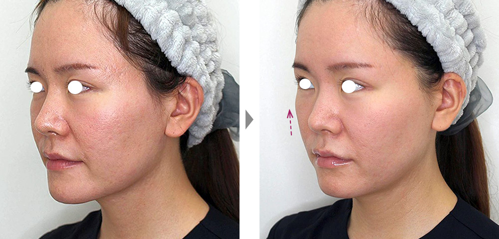 【スレッドコンビ治療】3種のスレッドで中顔面のたるみを改善の症例写真ビフォーアフター