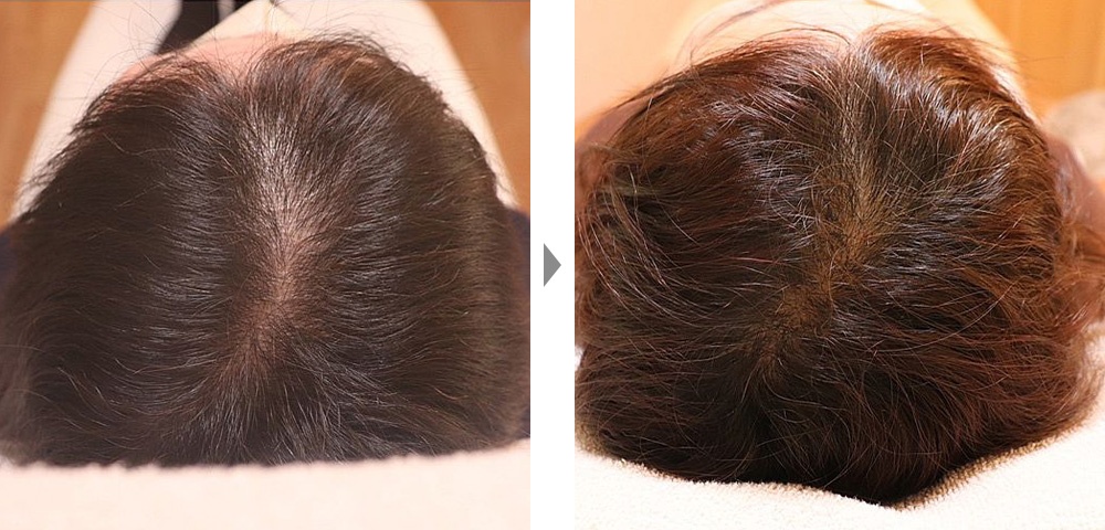 【薄毛治療（エクソソーム注射）】再生医療による女性の薄毛治療の症例写真ビフォーアフター