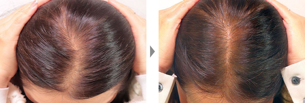 【薄毛治療（エクソソーム注入）】女性のびまん性脱毛症治療